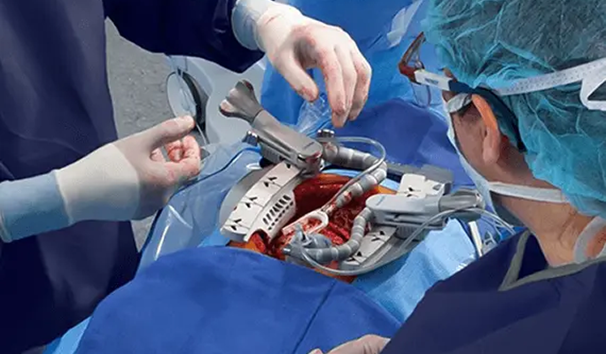 Open Heart Surgery
