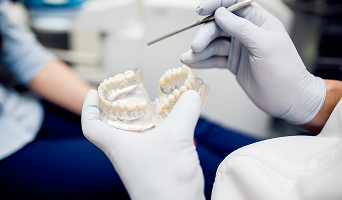 All on 6 Dental Implants