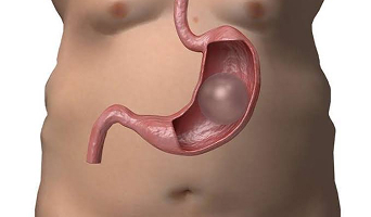 Gastric Balloon